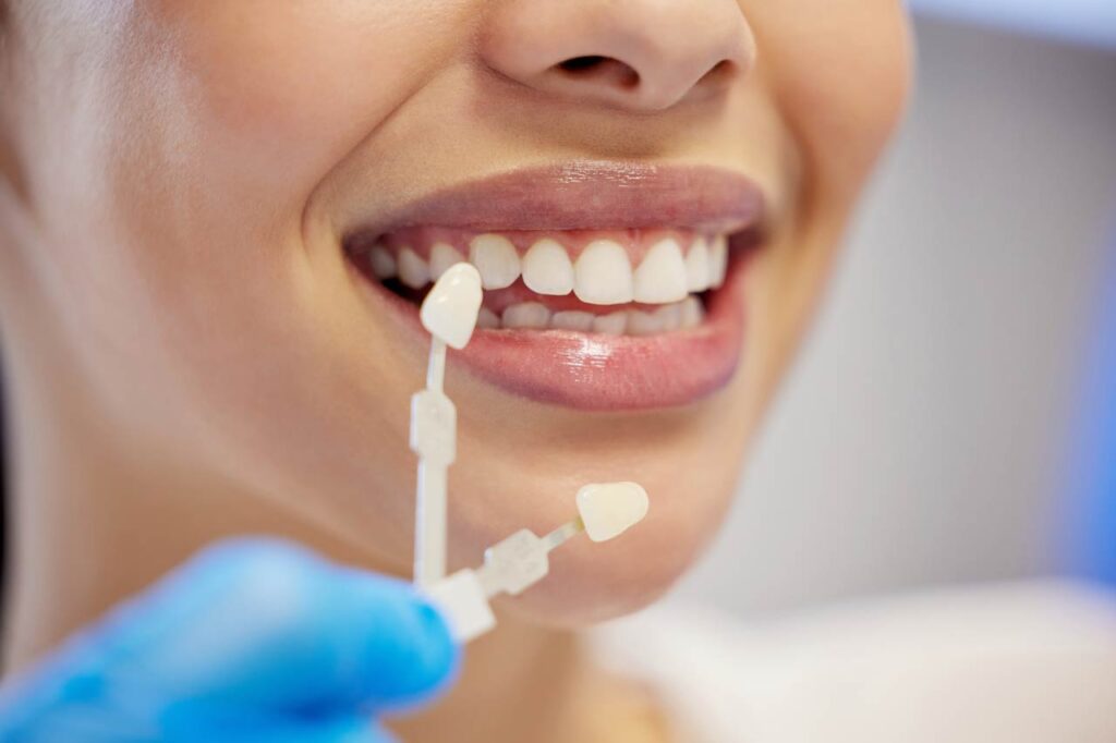 Mujer a la que le están colocando una carilla en los dientes en la clínica dental.