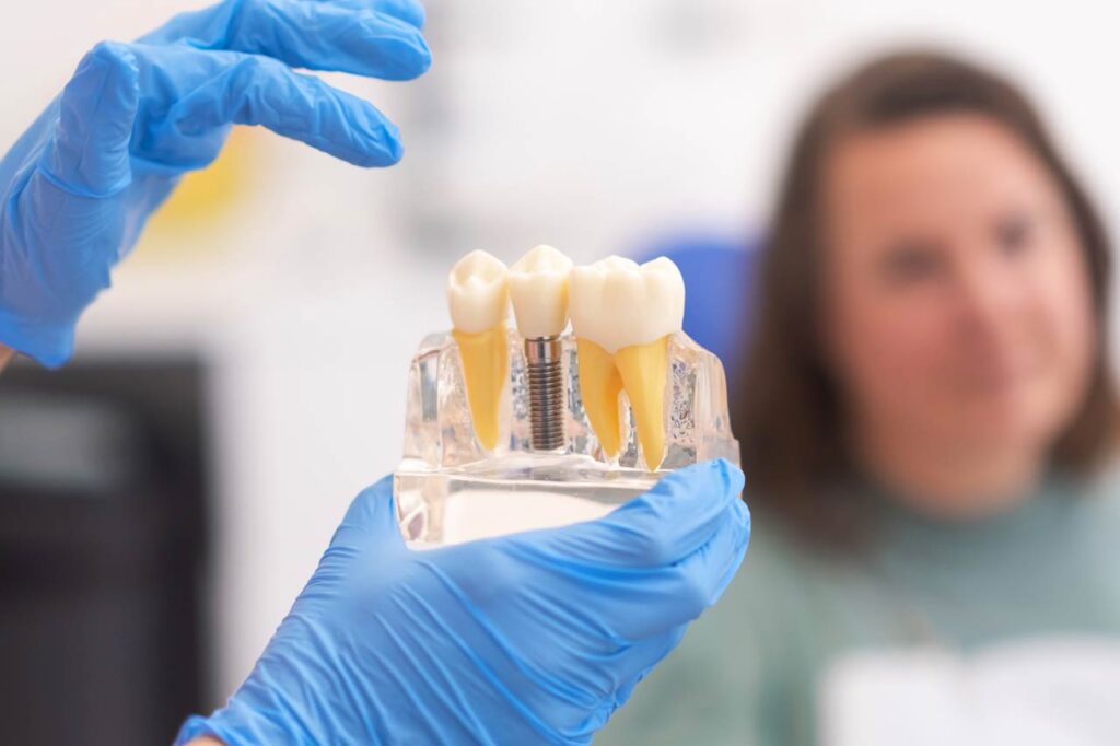 Primer plano de un modelo dental con implante. Paciente de una clínica dental sobre fondo borroso. Conceptos de odontología.