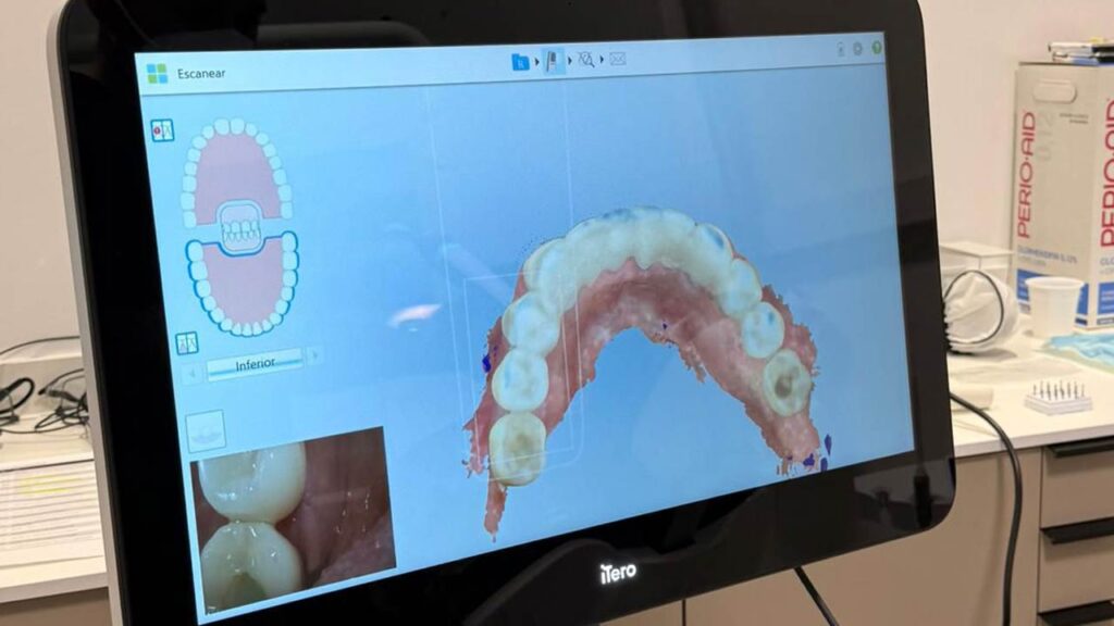 Imagen del escáner intraoral de un paciente