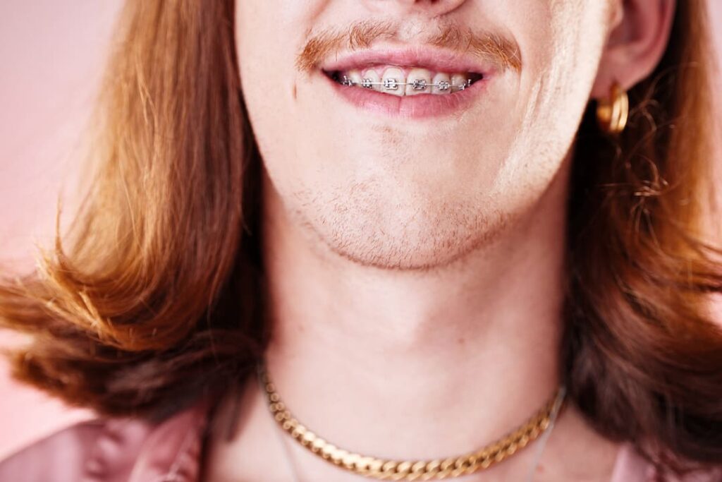 Persona sonriendo con grillz metálicos en los dientes como complemento de estética dental.