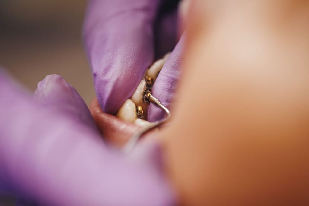 Odontólogo colocando una joya dental decorativa sobre la superficie de un diente.