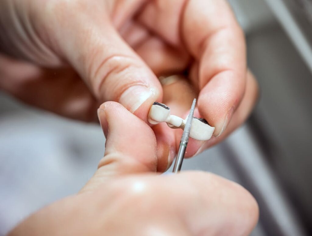 Proceso profesional de adhesión de una gema dental utilizando instrumental odontológico especializado.